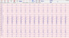 Mini PC ECG Device Ambulatory ECG Monitoring With Stable Software CE Approval