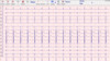 Mini PC ECG Device Ambulatory ECG Monitoring With Stable Software CE Approval